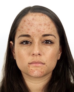 Woman's face with scarring across the forehead and chin